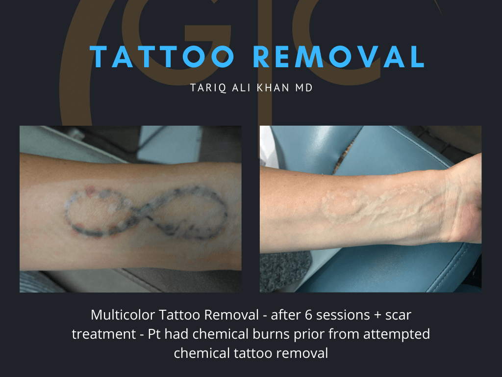 Gentle Care Laser Tustin & Long Beach CA Before and After picture - Tattoo Removal